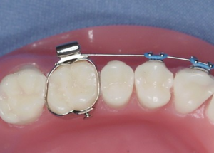 L appareil multi attaches B Ortho