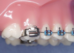 Bague orthodontique on sale molaire